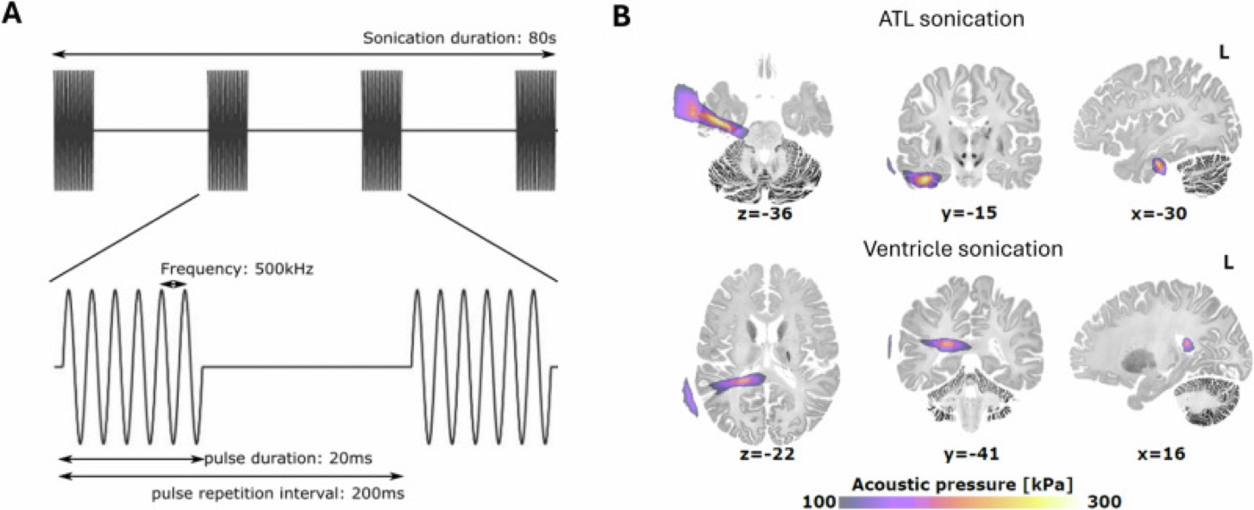 Ultrasound to the semantic hub. Targeting and acoustic simulation of theta-burst ultrasound to the anterior temporal lobe.