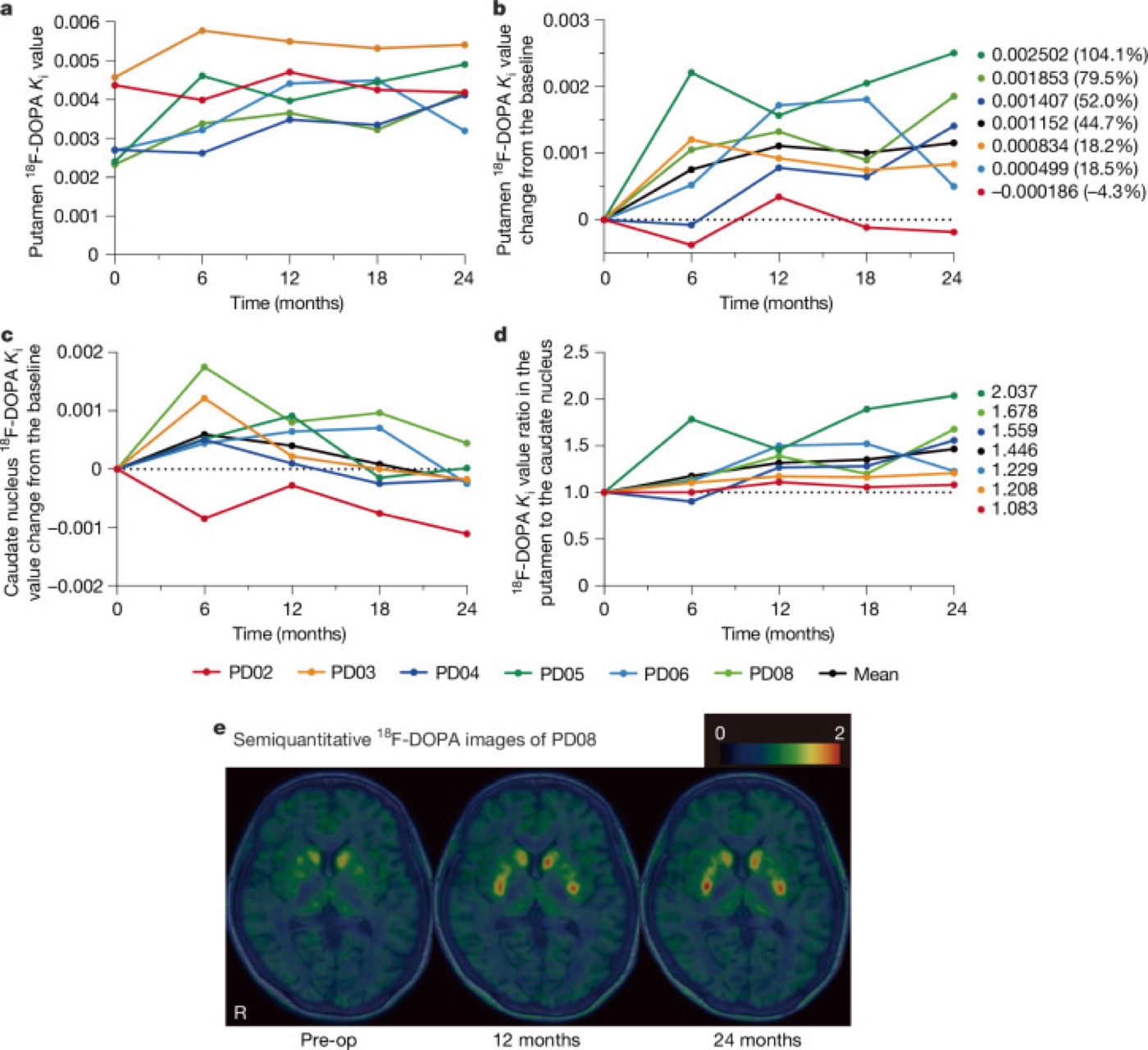 Replacing lost neurons with iPS cells. Dopamine synthesis detected by 18F-DOPA PET after transplanting iPS-cell-derived progenitors.