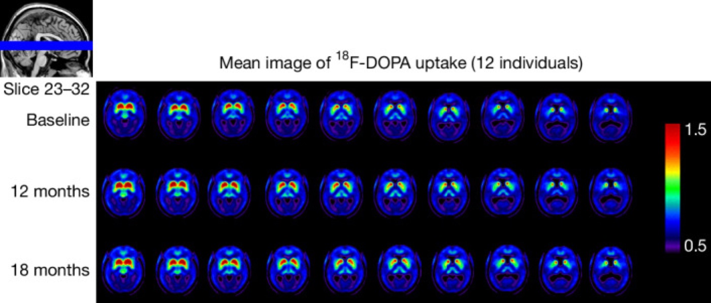 Replacing lost neurons with stem cells. 18F-DOPA PET signal in the striatum after grafting embryonic-stem-cell-derived dopaminergic progenitors.